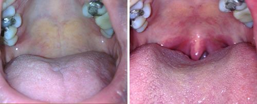 NightLase treatment result example 1