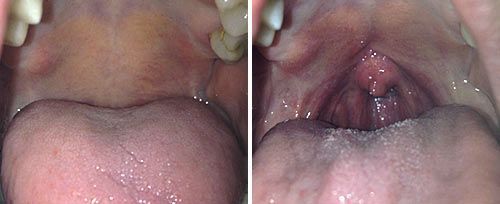 NightLase treatment result example 3